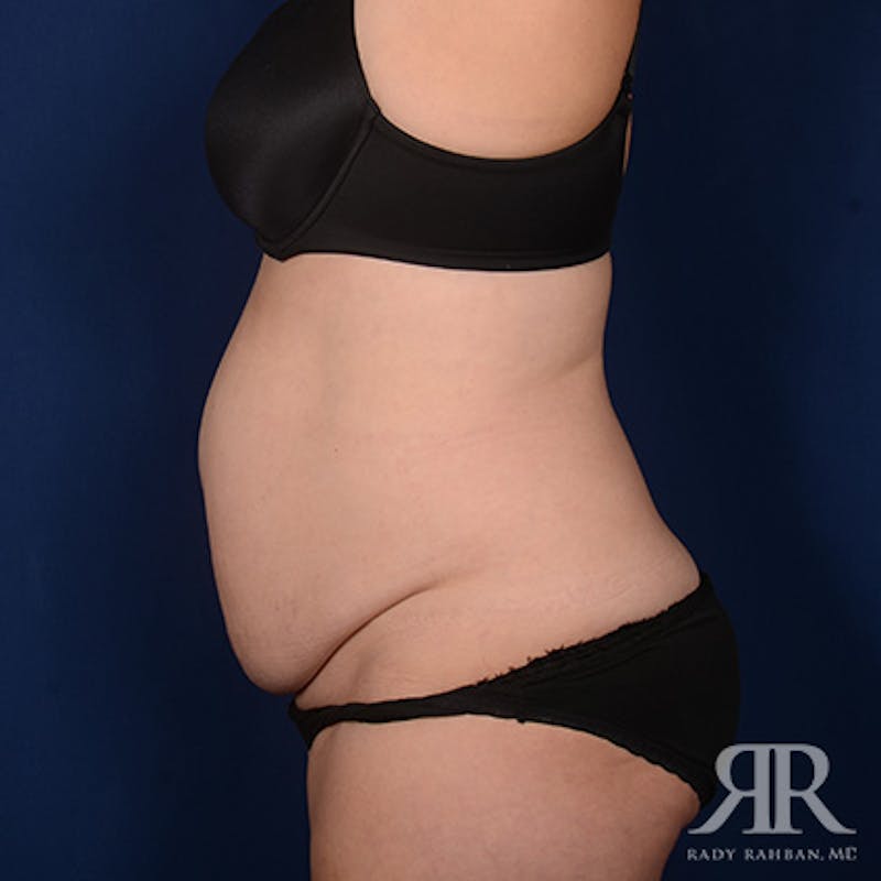 Severe Diastasis Recti Before & After Gallery - Patient 958341 - Image 5