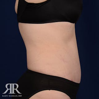 Tummy Tuck Before & After Gallery - Patient 101404 - Image 6