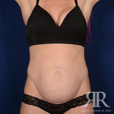 Severe Diastasis Recti Before & After Gallery - Patient 222590 - Image 1