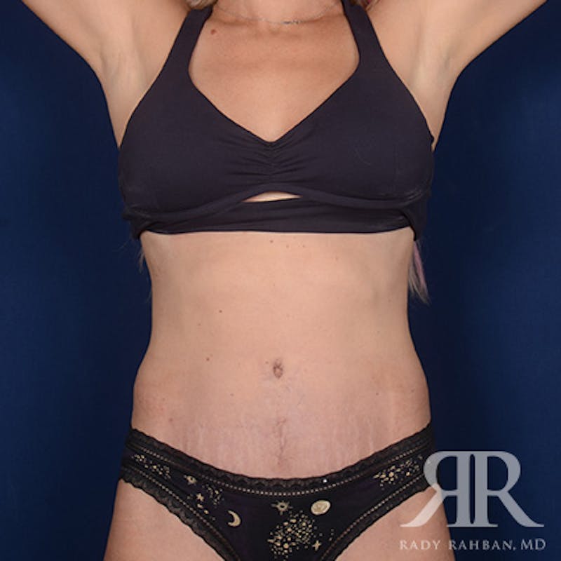 Severe Diastasis Recti Before & After Gallery - Patient 222590 - Image 2