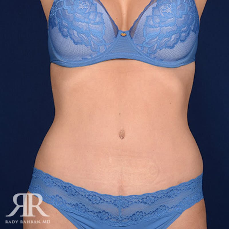 Tummy Tuck Before & After Gallery - Patient 406782 - Image 2