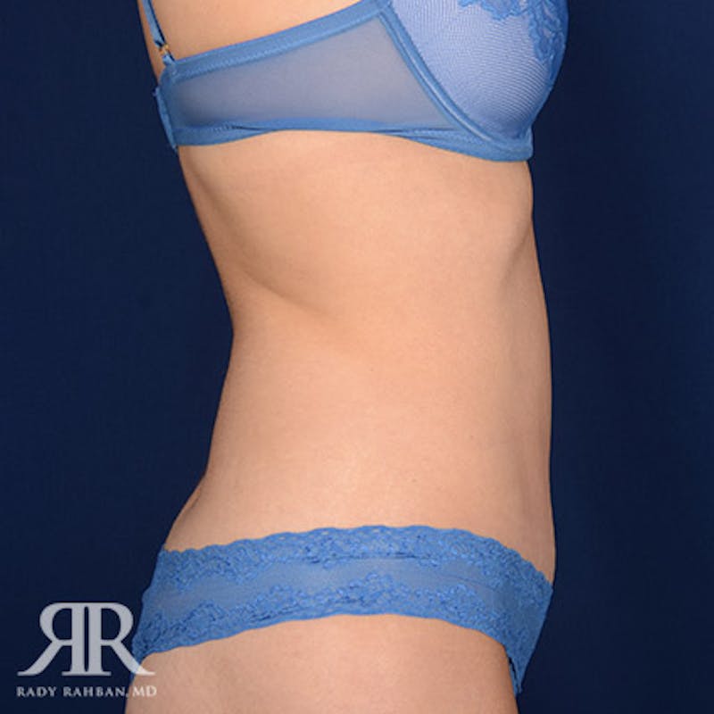Tummy Tuck Before & After Gallery - Patient 406782 - Image 6