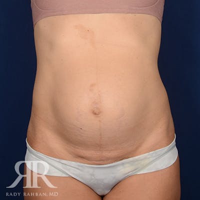 Severe Diastasis Recti Before & After Gallery - Patient 564415 - Image 1