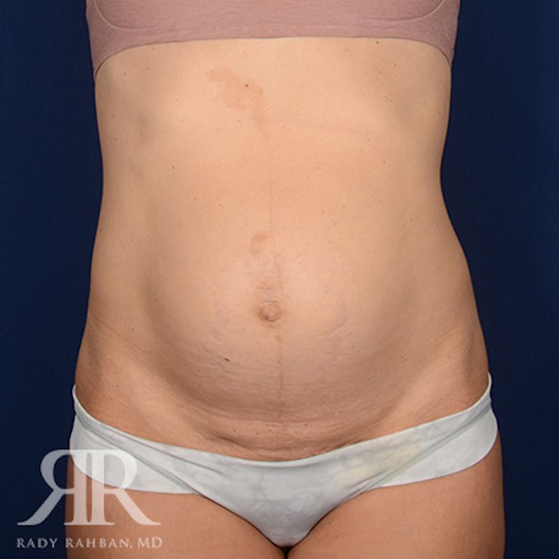 Severe Diastasis Recti Before & After Gallery - Patient 564415 - Image 1