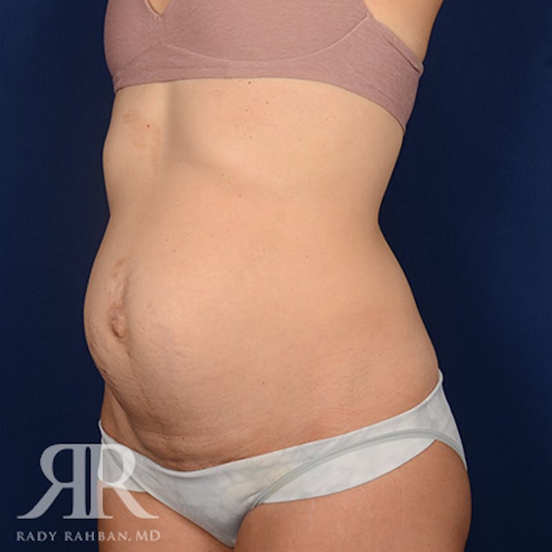 Severe Diastasis Recti Before & After Gallery - Patient 564415 - Image 3