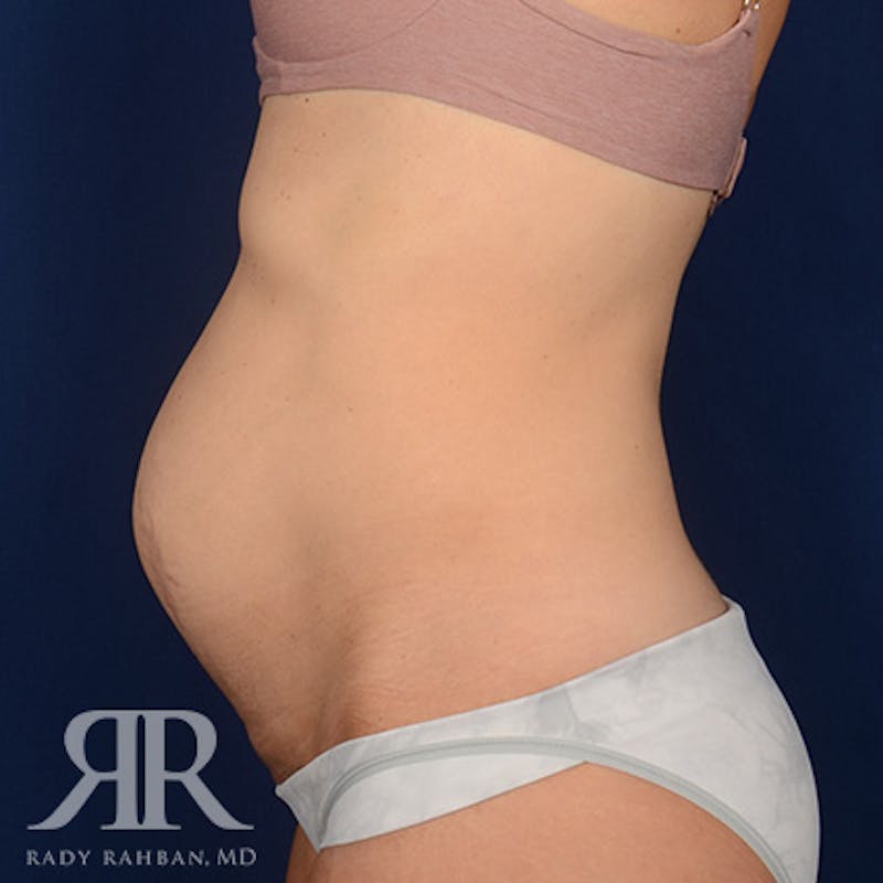 Severe Diastasis Recti Before & After Gallery - Patient 564415 - Image 5