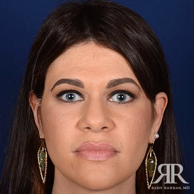 Female Rhinoplasty Before & After Gallery - Patient 105317 - Image 1