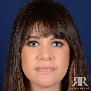 Female Rhinoplasty Before & After Gallery - Patient 105317 - Image 2