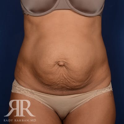 Severe Diastasis Recti Before & After Gallery - Patient 409957 - Image 1