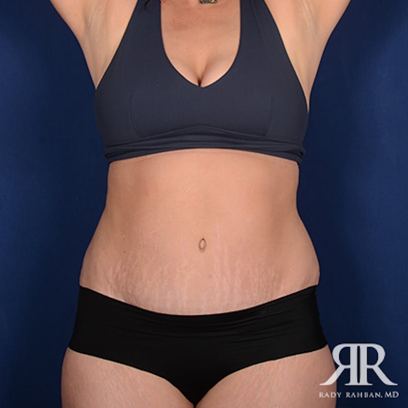 Tummy Tuck Before & After Gallery - Patient 226619 - Image 2