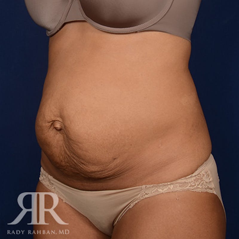 Severe Diastasis Recti Before & After Gallery - Patient 409957 - Image 3