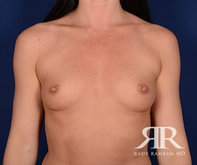 Breast Augmentation Before & After Gallery - Patient 264390 - Image 1