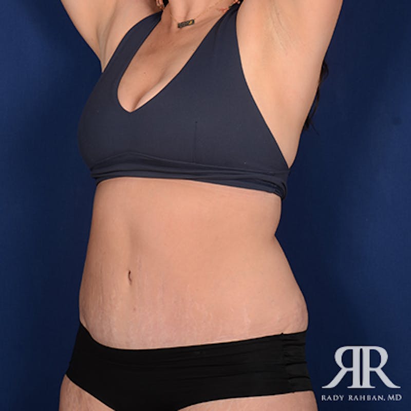Tummy Tuck Before & After Gallery - Patient 226619 - Image 4