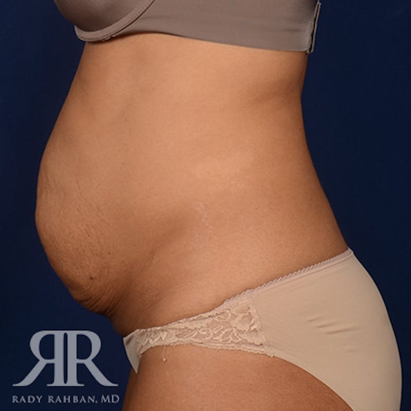 Severe Diastasis Recti Before & After Gallery - Patient 409957 - Image 5