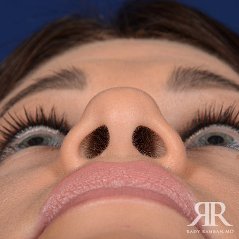 Female Rhinoplasty Before & After Gallery - Patient 105317 - Image 7