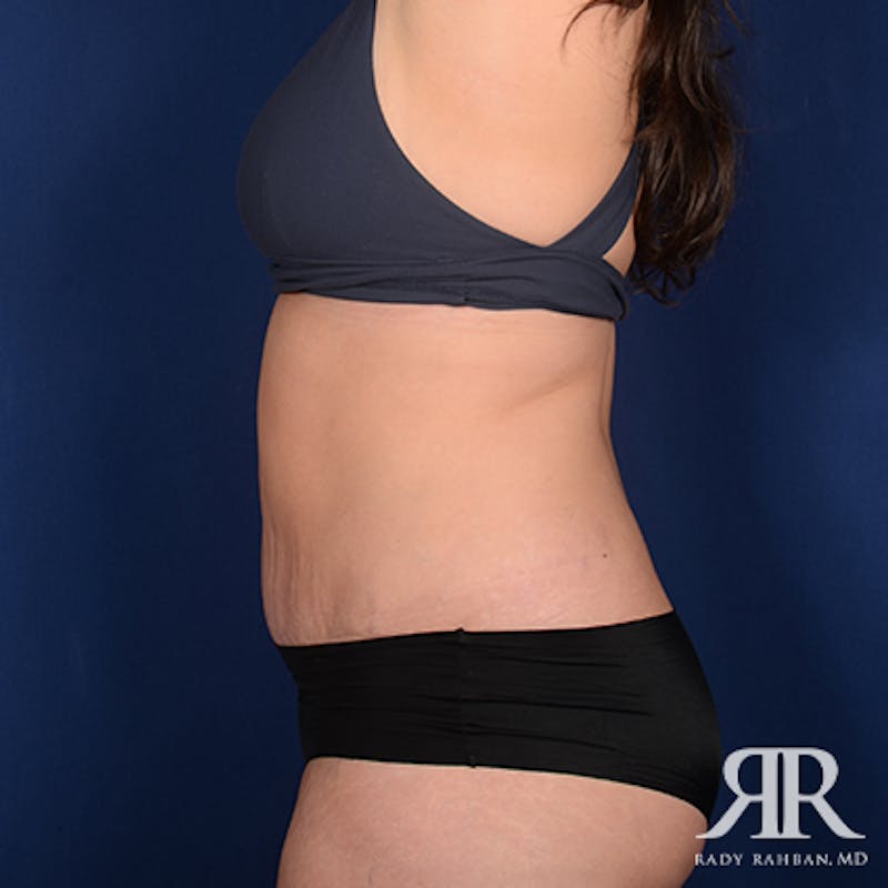 Tummy Tuck Before & After Gallery - Patient 226619 - Image 6