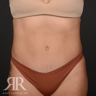 Severe Diastasis Recti Before & After Gallery - Patient 207937 - Image 2