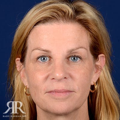 Female Rhinoplasty Before & After Gallery - Patient 295582 - Image 2