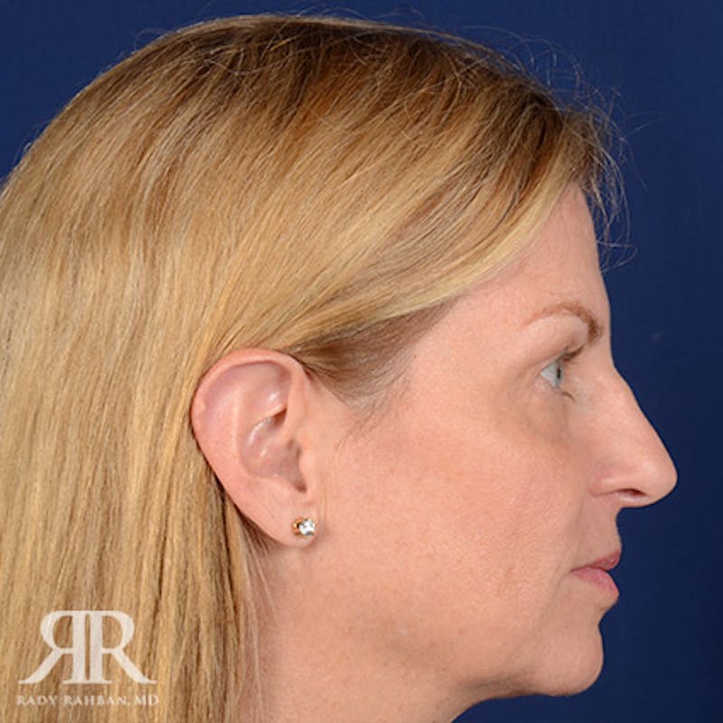 Female Rhinoplasty Before & After Gallery - Patient 295582 - Image 5