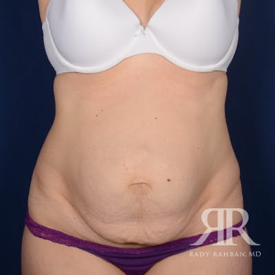 Severe Diastasis Recti Before & After Gallery - Patient 106616 - Image 1