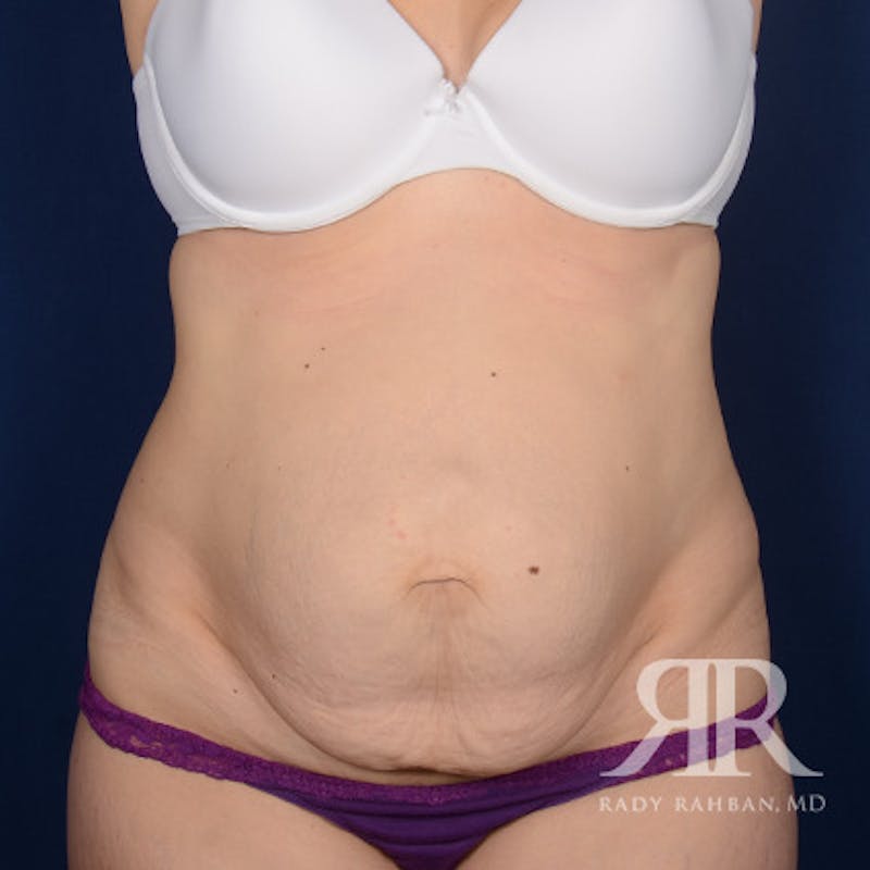 Severe Diastasis Recti Before & After Gallery - Patient 106616 - Image 1