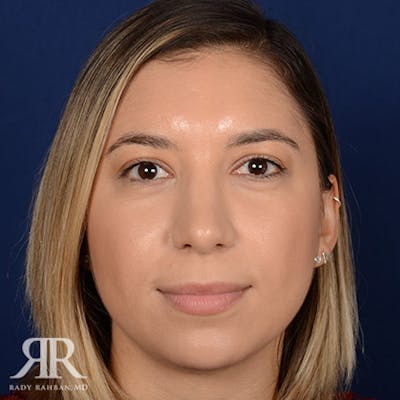 Female Rhinoplasty Before & After Gallery - Patient 305250 - Image 2