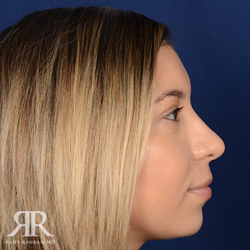 Female Rhinoplasty Before & After Gallery - Patient 305250 - Image 6