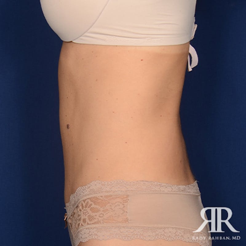 Tummy Tuck Before & After Gallery - Patient 278654 - Image 6