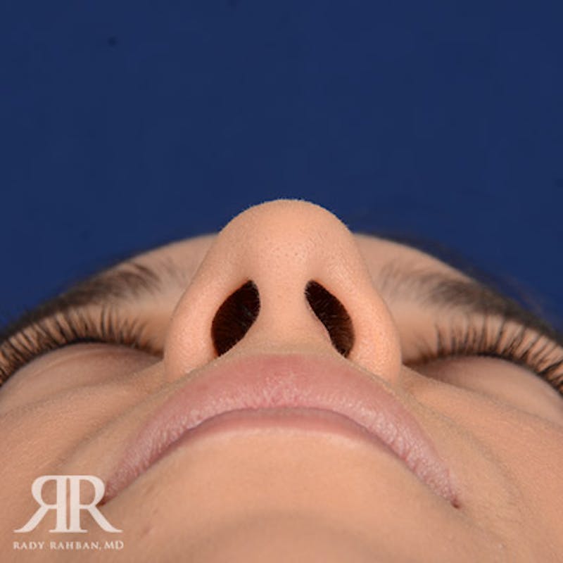 Female Rhinoplasty Before & After Gallery - Patient 305250 - Image 7