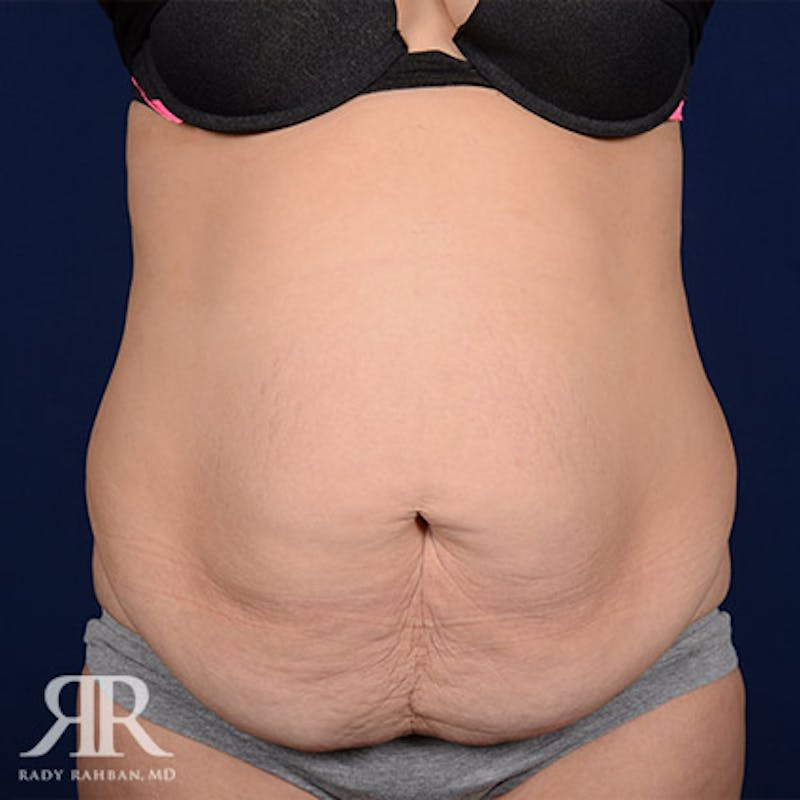 Tummy Tuck Before & After Gallery - Patient 238218 - Image 1