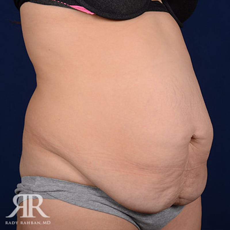 Tummy Tuck Before & After Gallery - Patient 238218 - Image 3