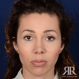 Female Rhinoplasty Before & After Gallery - Patient 288448 - Image 2