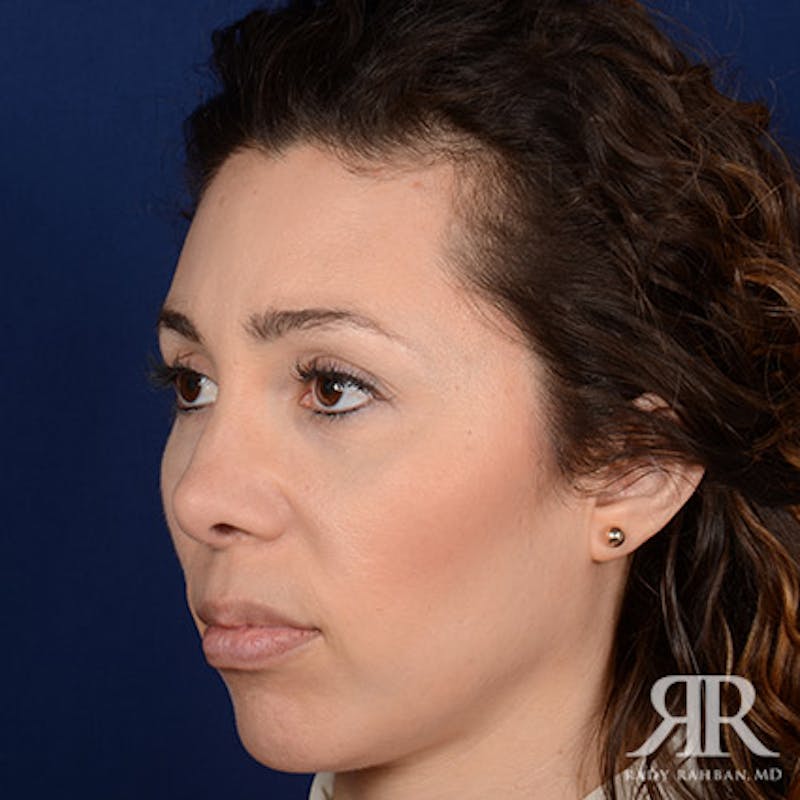 Female Rhinoplasty Before & After Gallery - Patient 288448 - Image 4