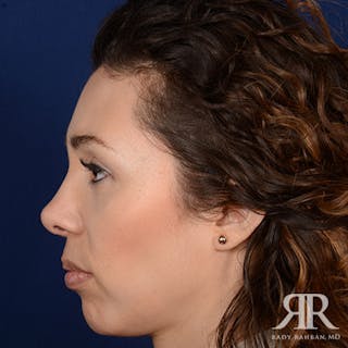 Female Rhinoplasty Before & After Gallery - Patient 288448 - Image 6