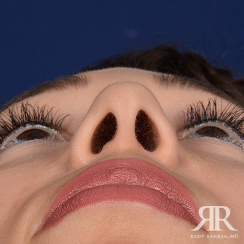 Female Rhinoplasty Before & After Gallery - Patient 288448 - Image 7
