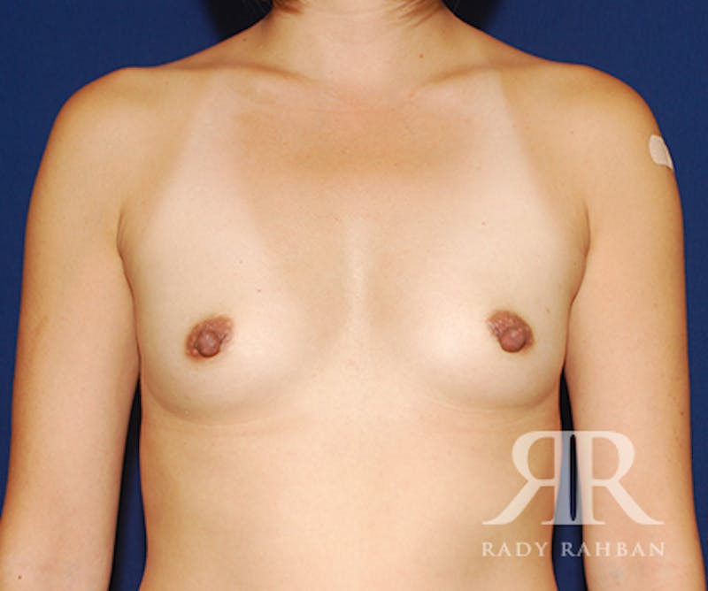 Breast Augmentation Before & After Gallery - Patient 314525 - Image 1
