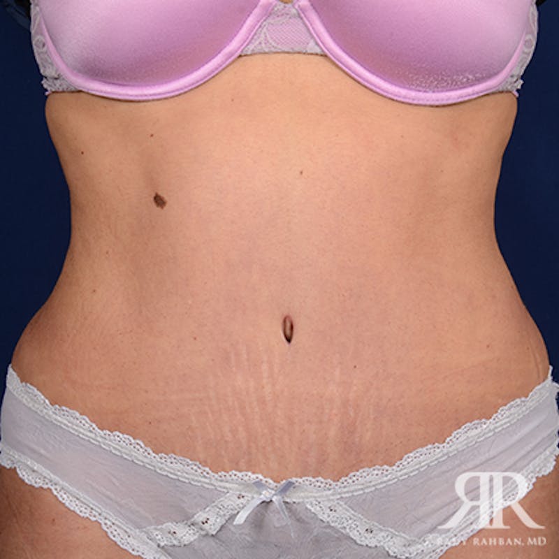 Tummy Tuck Before & After Gallery - Patient 133558 - Image 2