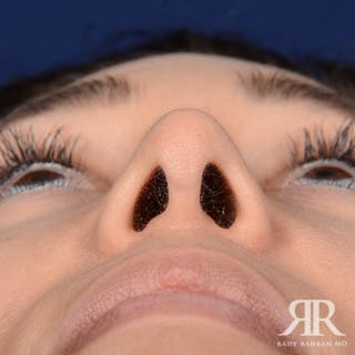 Female Rhinoplasty Before & After Gallery - Patient 288448 - Image 8