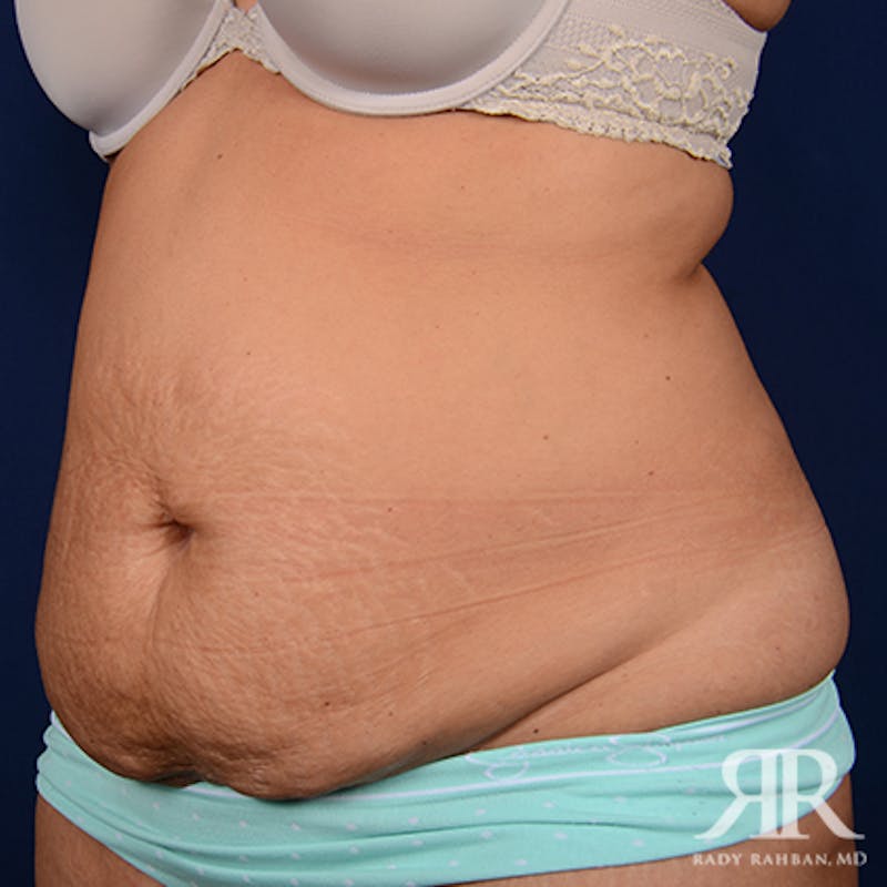 Tummy Tuck Before & After Gallery - Patient 133558 - Image 3