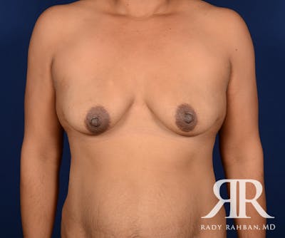 Breast Lift Before & After Gallery - Patient 113573 - Image 1