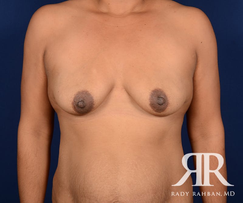Breast Lift Before & After Gallery - Patient 113573 - Image 1