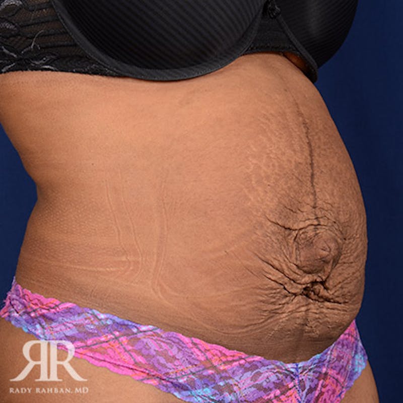 Tummy Tuck Before & After Gallery - Patient 117786 - Image 3