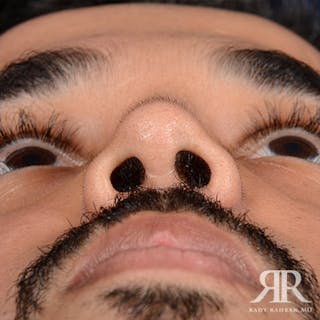 Male Rhinoplasty Before & After Gallery - Patient 418735 - Image 8