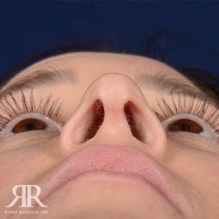 Female Rhinoplasty Before & After Gallery - Patient 151969 - Image 8