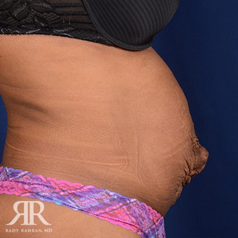 Tummy Tuck Before & After Gallery - Patient 117786 - Image 5