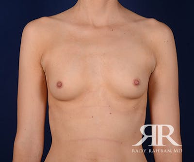 Breast Augmentation Before & After Gallery - Patient 147904 - Image 1
