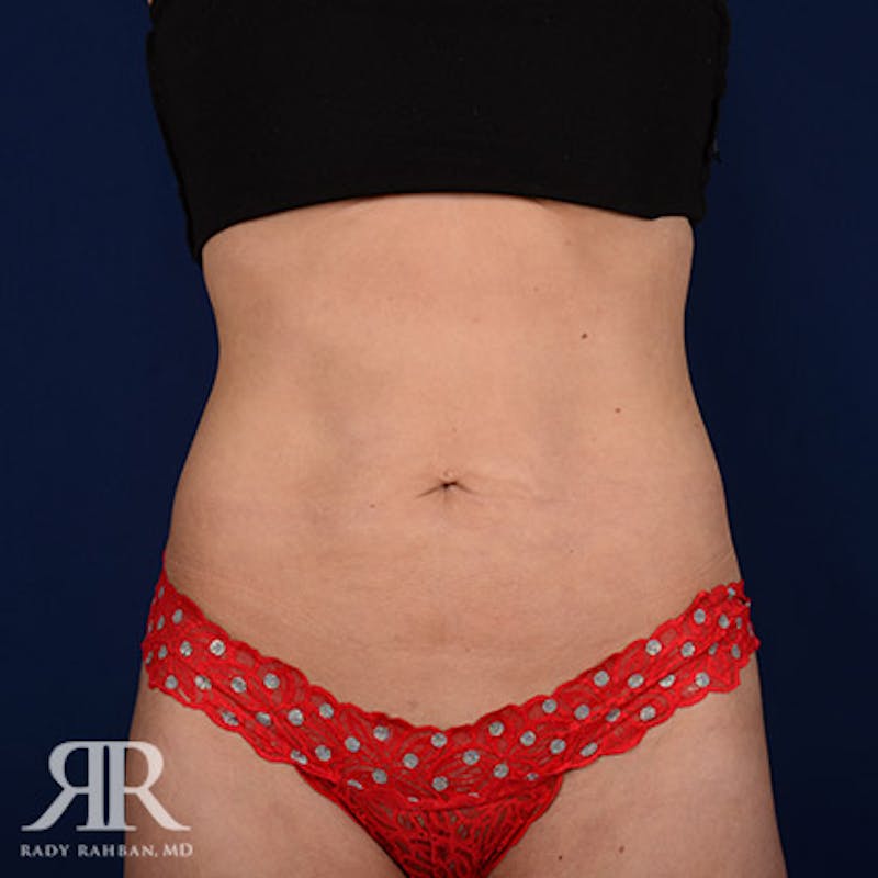 Tummy Tuck Before & After Gallery - Patient 860348 - Image 1