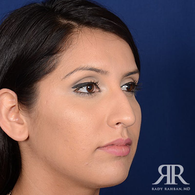 Female Rhinoplasty Before & After Gallery - Patient 572311 - Image 3