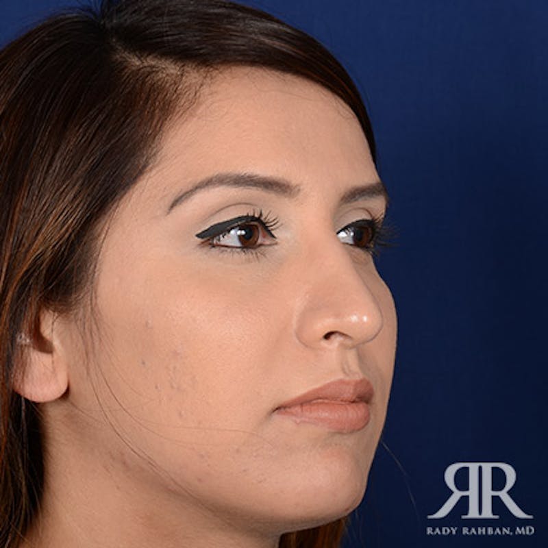 Female Rhinoplasty Before & After Gallery - Patient 572311 - Image 4