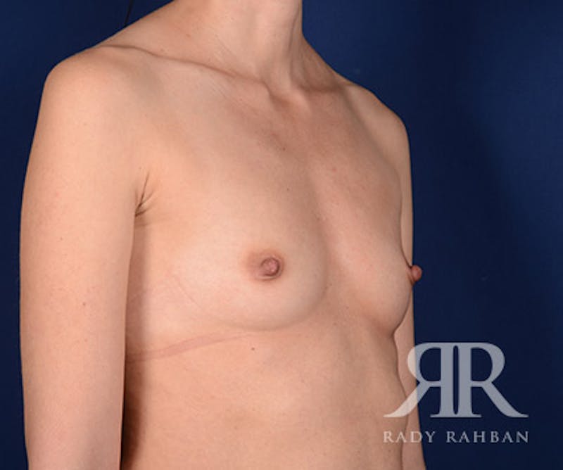 Breast Augmentation Before & After Gallery - Patient 147904 - Image 3